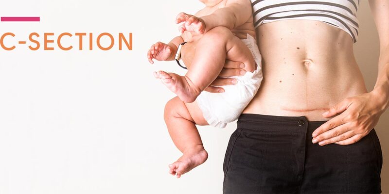 Cesarean c-section Recovery Kit -  UK