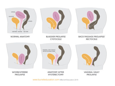 Prolapse image Prolapse image