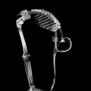 osteoporosis osteoporosis
