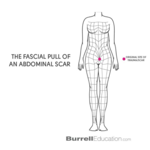 abdonial scar abdonial scar